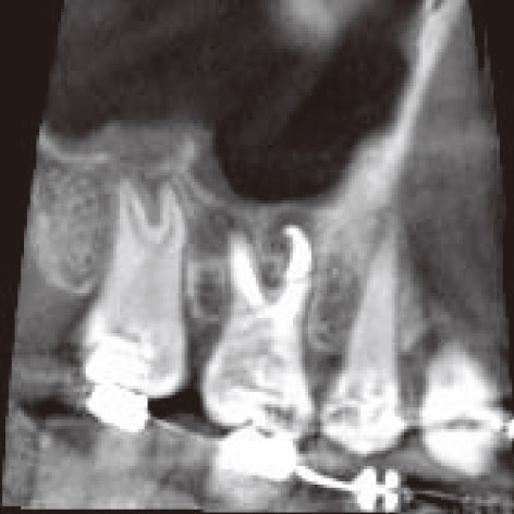 図3A 感染根管治療術後の画像（管電流8ｍA）。