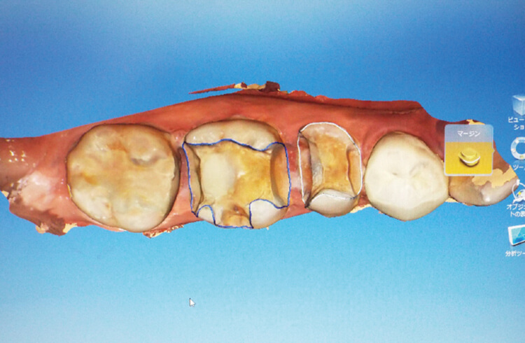 オムニカムでスキャン後にマージンラインを設定。窩洞形成の良否により、その難易度が左右される。