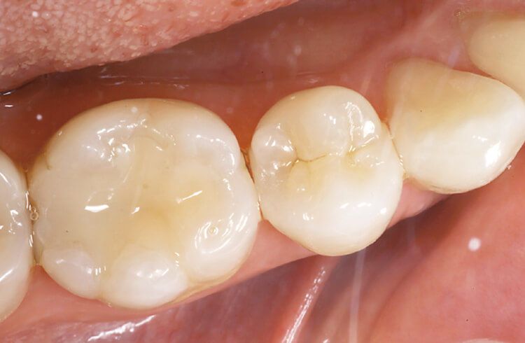 冷水痛のある 65 部にX線にて象牙質に達するう蝕を認めた。