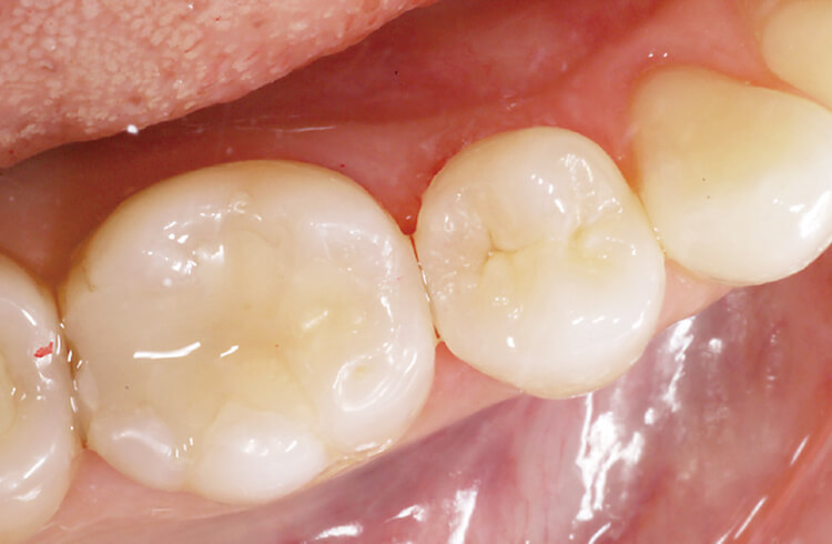 充填ミスが起こりやすい臼歯部隣接面部でも、適切な充填補助器具の使用で精度の高い充填が可能になる。