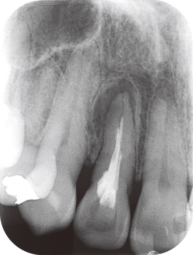 図1　口内法X線写真では一般的な根尖病巣として見られる。
