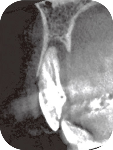 図2　同部位のCBCT矢状断像。舌側骨が大きく消失している。