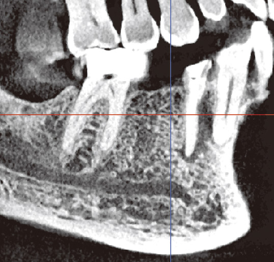 図7　断面厚を0.5mmで表示した。根管の観察に向いている。