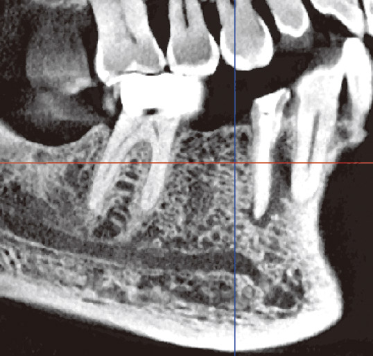図8　断面厚を1.0mmで表示したもので、一般的な顎骨の観察に向いている。