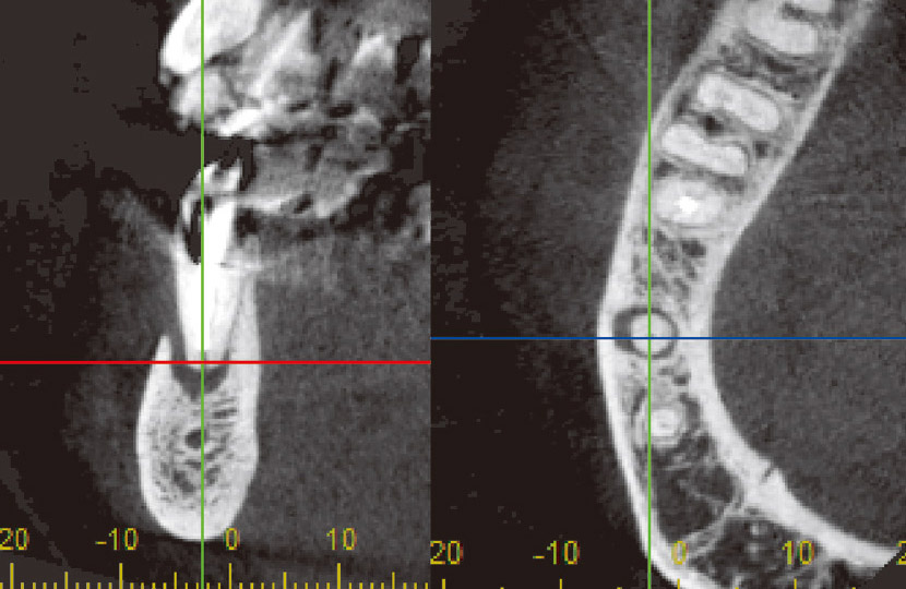 図15　薄い頰側骨（唇側骨）の観察において、根尖レベルにおける横断像では頰側骨はしっかり残っている。