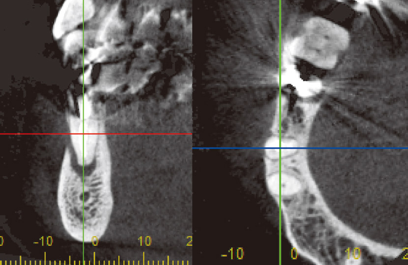 図17　歯頸部近くの横断像では、歯根が頰側骨から露出している。