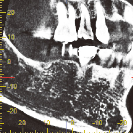 図18　66歳女性。顎骨全体の骨粗鬆症変化。皮質は非常に薄くなり、骨梁構造は細片化・断片化し、さらに粗になっている。インプラントの生着は困難。