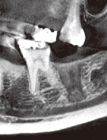 図20　40歳女性。抜去後約1年経過。抜歯窩の天井は薄い皮質骨が形成されているが、抜歯窩内は弱い石灰化で脆弱な構造。生着は期待できない。