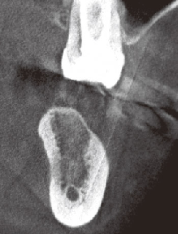 図21　図20の歯列直交断像。