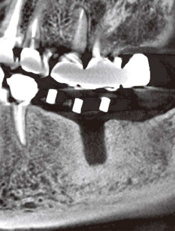 図22　インプラントを植立したが数か 図23　図22の歯列直交断像。月後に脱落した。脱落部の周囲は広範囲にわたり強い骨硬化症を呈しており、osteointegrationは期待できない。