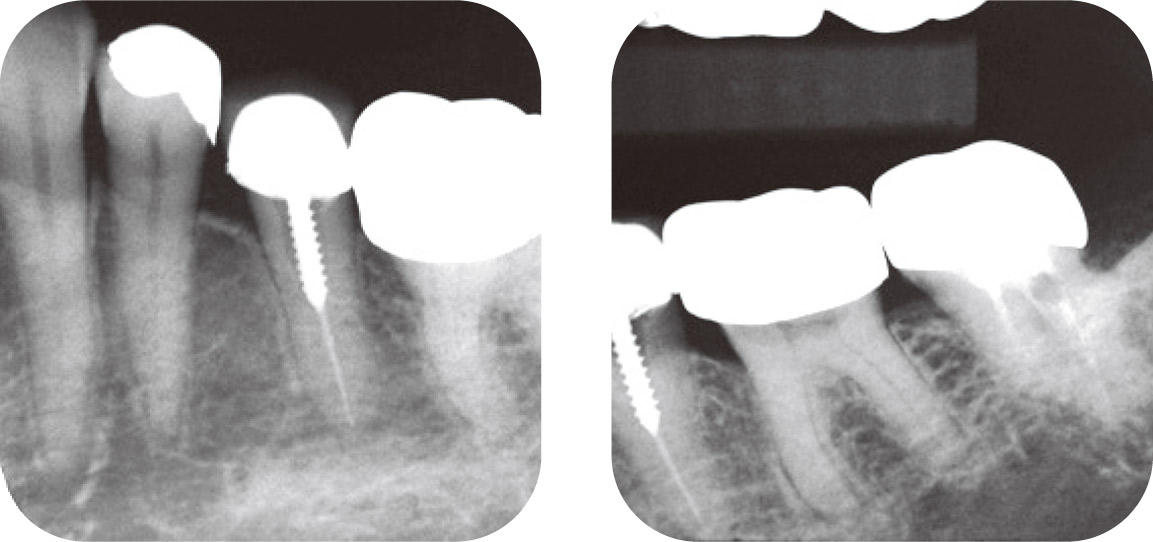図5a、b 4567 に2次う蝕があり再修復を行う。デンタルでは根尖病変を認めず、歯内療法を行うべきか迷う。