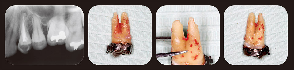 図1　上顎左側第一小臼歯、矯正治療のため抜歯を行った。デンタルX線写真では根充材が根尖を超えているようには見えない。しかし抜去歯牙の根尖では根充材が根尖を超えて充填されていた。