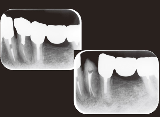 図2　下顎第1小臼歯は2根管存在することもある。デンタルX線写真では偏心投影で撮影すれば確認することもできるが、常に2根管あるかもしれないと頭の中になければ見落としてしまう。