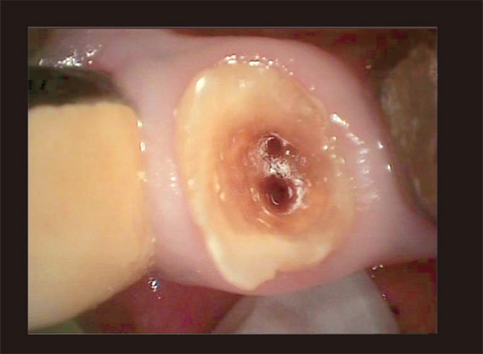 図3　マイクロスコープが無くても部位によれば根管を探すことは可能と思われる。未治療の舌側根管がみられた。