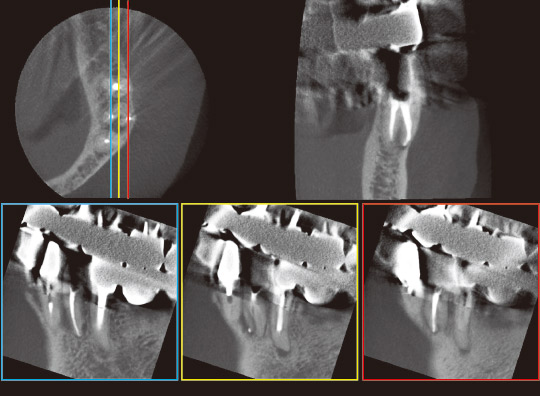 図4　CT写真。青枠が舌側、黄枠が頰舌的中央、赤枠が頰側を示す。