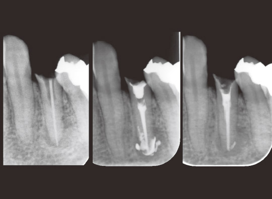 図5　左より治療開始時、水酸化カルシウム製剤貼薬時、治療開始3ヵ月後の根充時のデンタルX線写真。