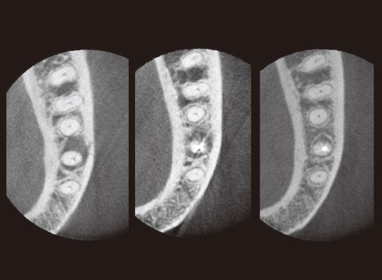 図6　CT写真（冠状断）。左より治療開始時、根充時、治療開始6ヵ月後の根充時。
