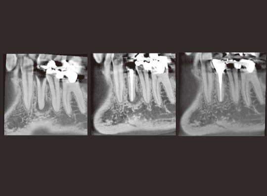 図7　CT写真（矢状断）。左より治療開始時、根充時、治療開始6ヵ月後の根充時。
