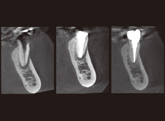 図8　CT写真（軸断）。左より治療開始時、根充時、治療開始6ヵ月後の根充時。