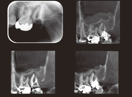 図9　左上：治療開始時デンタルX線写真。右上：治療開始時CT写真（矢状断）。下左：根充後CT写真（矢状断）。下右：治療後6ヵ月CT写真（矢状断）。