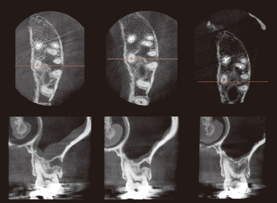 図10　CT写真（冠状断と軸断）。左より術前、根充時、治療後6ヵ月。軸断は6の近心根と遠心根の中央（赤線）を示す。