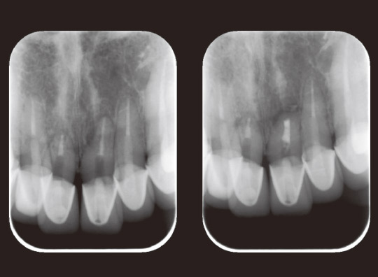 図11　術前、術後のデンタルX線写真。