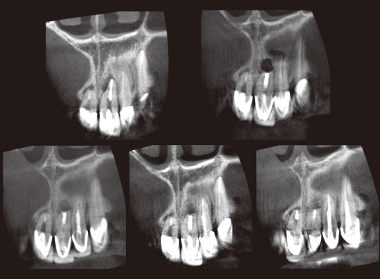 図12　CT写真（軸断）。左上は術前、右上は術直後、左下から順に術後3ヵ月、6ヵ月、9ヵ月を示す。