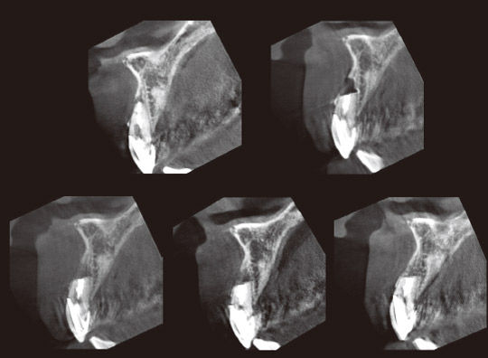 図13　CT写真（矢状断）。左上は術前、右上は術直後、左下から順に術後3ヵ月、6ヵ月、9ヵ月を示す。