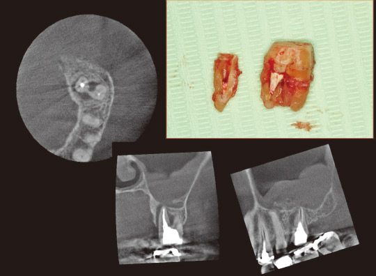 図14　術前CT写真と抜去歯牙。口蓋根が頰舌的に破折していた。