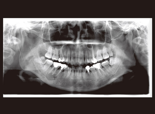 図15　初診時パノラマX線写真。