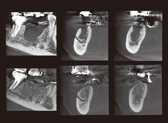 図17　CT写真（矢状断と軸断）。上：術直後、下：術後1年半。
