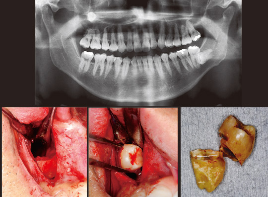 図18　初診時パノラマX線写真と術中写真および摘出した歯牙。