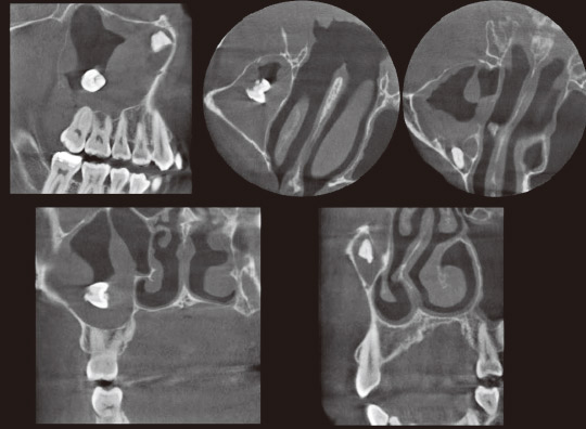 図19　術前CT写真。矢状断、冠状断、軸断で観察。上顎洞粘膜の肥厚とパノラマX線写真では確認できなかった上方にある分割された歯根が確認できた。