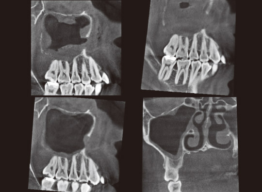 図20　CT写真。左上は術直後、右上は術後1週間の矢状断、下に術後3ヵ月目の矢状断、軸断を示す。