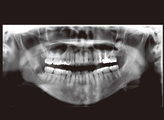図21　初診時パノラマX線写真