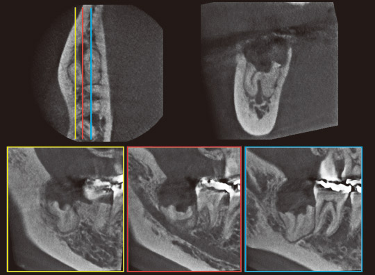 図22　CT写真。左上の冠状断で黄線は頰側、赤線は歯根間中央、青線は舌側であり、下にそれぞれの矢状断を示す。右上は軸断。