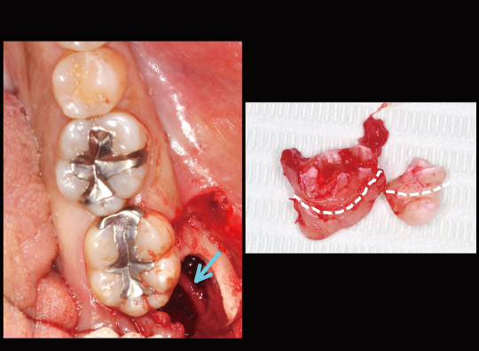 図23　術後口腔内写真と抜去歯牙：抜歯窩に下顎管より露出した下歯槽神経血管束がみられる（矢印）。分割して抜去した歯根内面に神経血管束の走行に沿う歯根形態が確認できる。