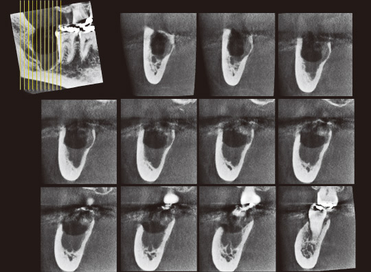 図24　抜歯直後の軸断連続断層写真。上方左より遠心からの断面を示す。下顎管壁が消失していることが確認できる。