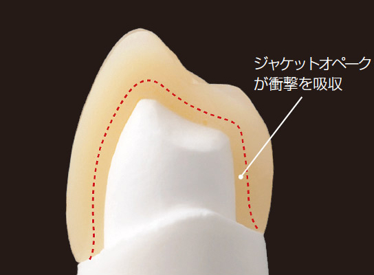 図3　ジャケットオペークを使用したHJCの断面図