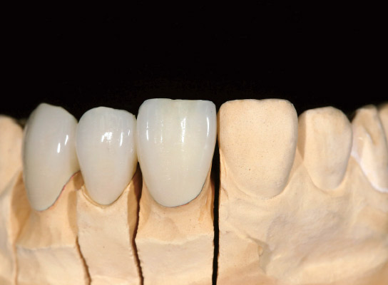 図22　ペーストタイプとフロータイプを併用した前装冠ブリッジ
