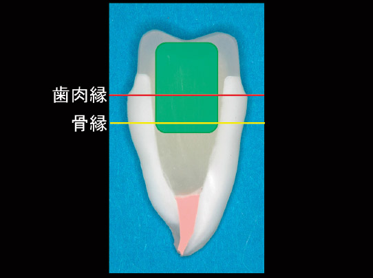 図4　緑枠の部分を補強する、という意識をもつことが大切である。