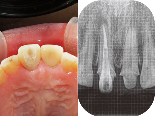 図22　重合完了後、形態を修正した状態とデンタルＸ線写真。今後隔壁代わりのテンポラリークラウンを削合除去し、改めてプロビジョナルレストレーションを装着後、歯根端切除術を施行予定。