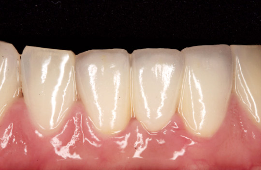 図27　 セメンティング一週間後の状態。下地となる支台歯の影響を受けて調和した色調が得られた。