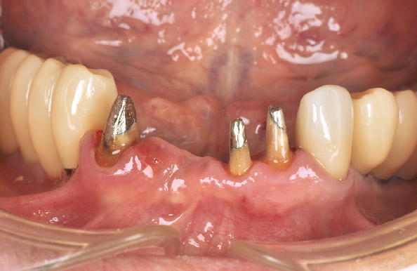 図8　支台歯の状態。メタルコア支台だが厚みを確保することでメタルの暗さを遮蔽することが可能である。