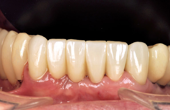 図9　臼歯部は研磨で、前歯部はステイン法で仕上げた。切端部が単調にならないように透明と不透明の表現を強調した。