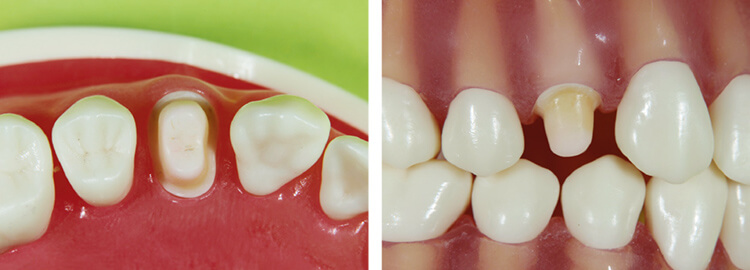 CAD/CAM冠に適した小臼歯ジャケットクラウンの支台歯形成。