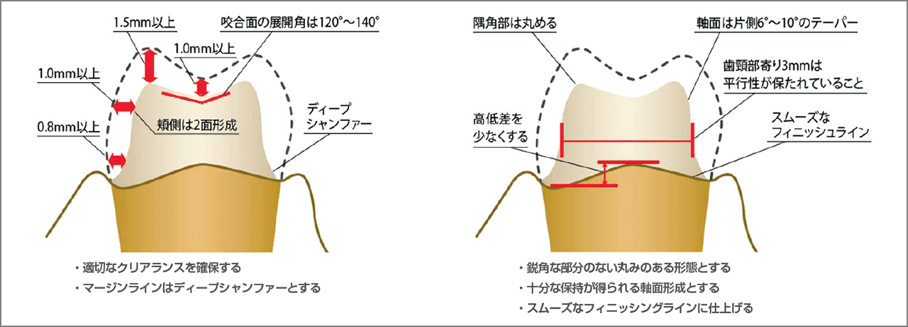 クラウンでの形成厚み、注意点