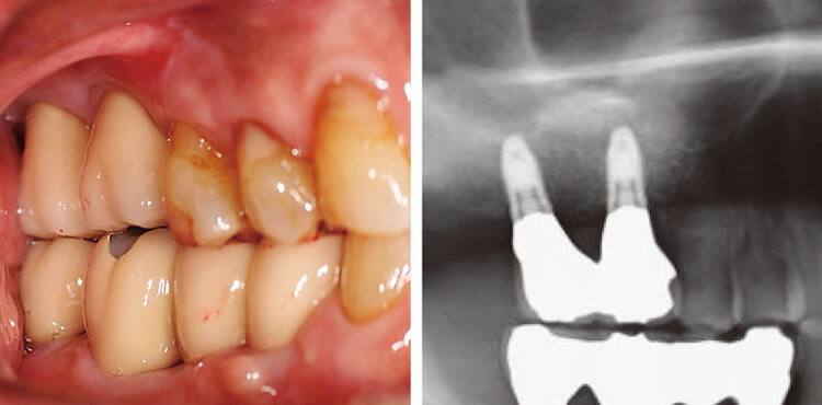 最終補綴装着時の口腔内およびX線写真