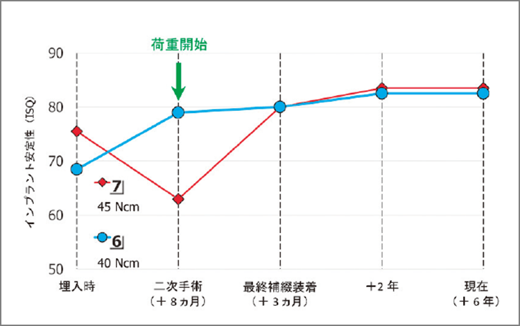 ISQ値の経時的変化（症例1）