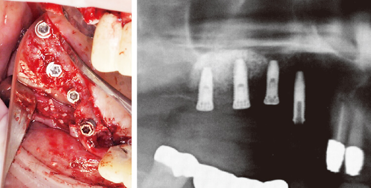 インプラント埋入＋上顎洞底挙上術の術中写真（ミラー像）とX線写真